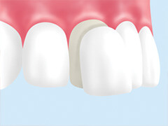 前歯の変色やすきっ歯を治したい