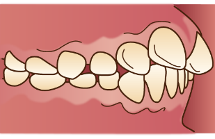 上顎前突