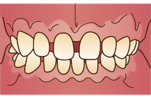 空隙歯列