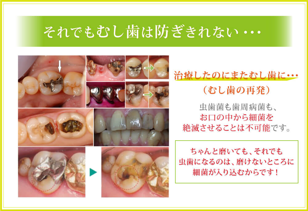 それでも虫歯は防ぎきれない…