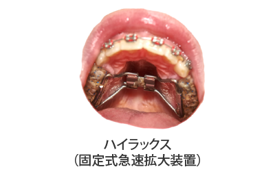 小児矯正